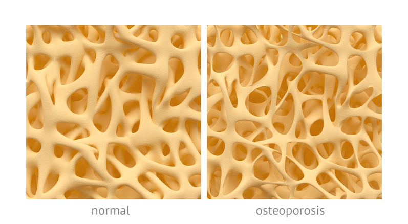 os avec structure normale et avec structure en cas d'ostéoporose